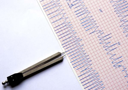 analyis of ecg